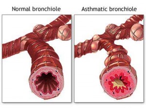 chronic asthma